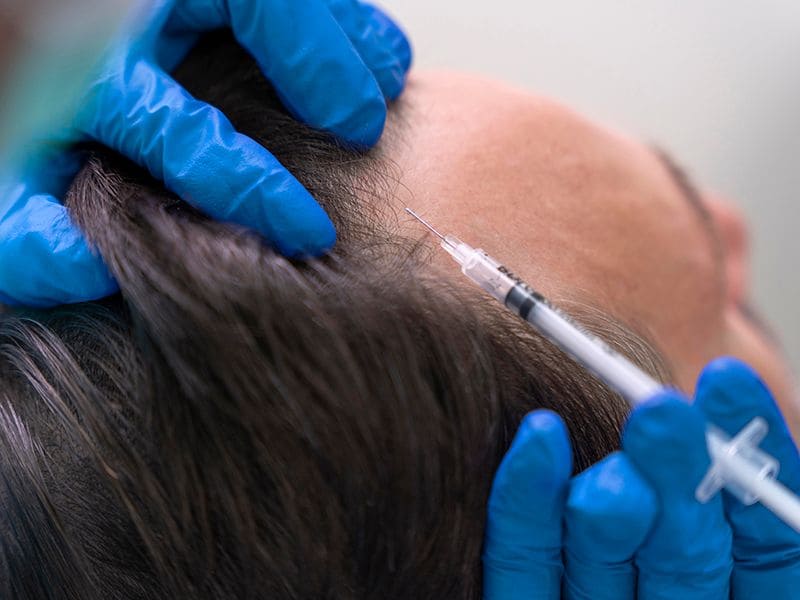 Ice Sapphire Hair Transplant