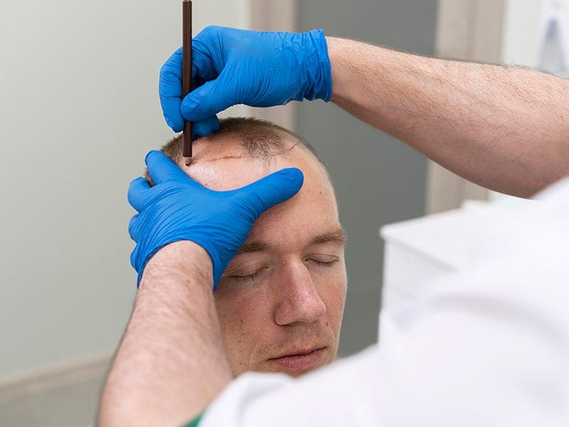 DHI Hair Transplant