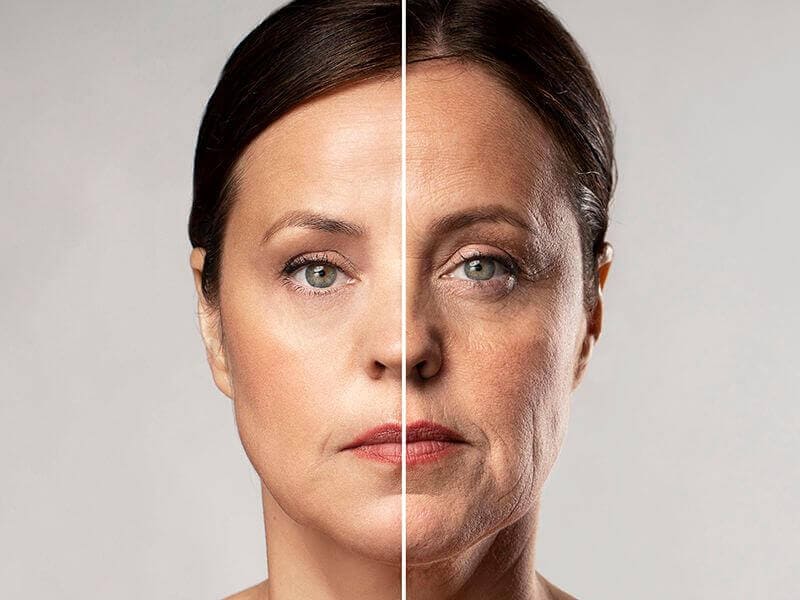 Face Lift