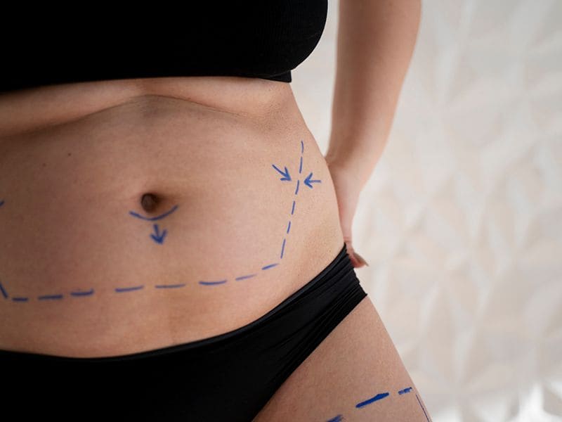 Liposuction