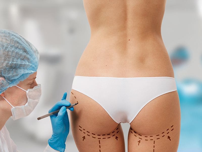Brazilian Butt Lift